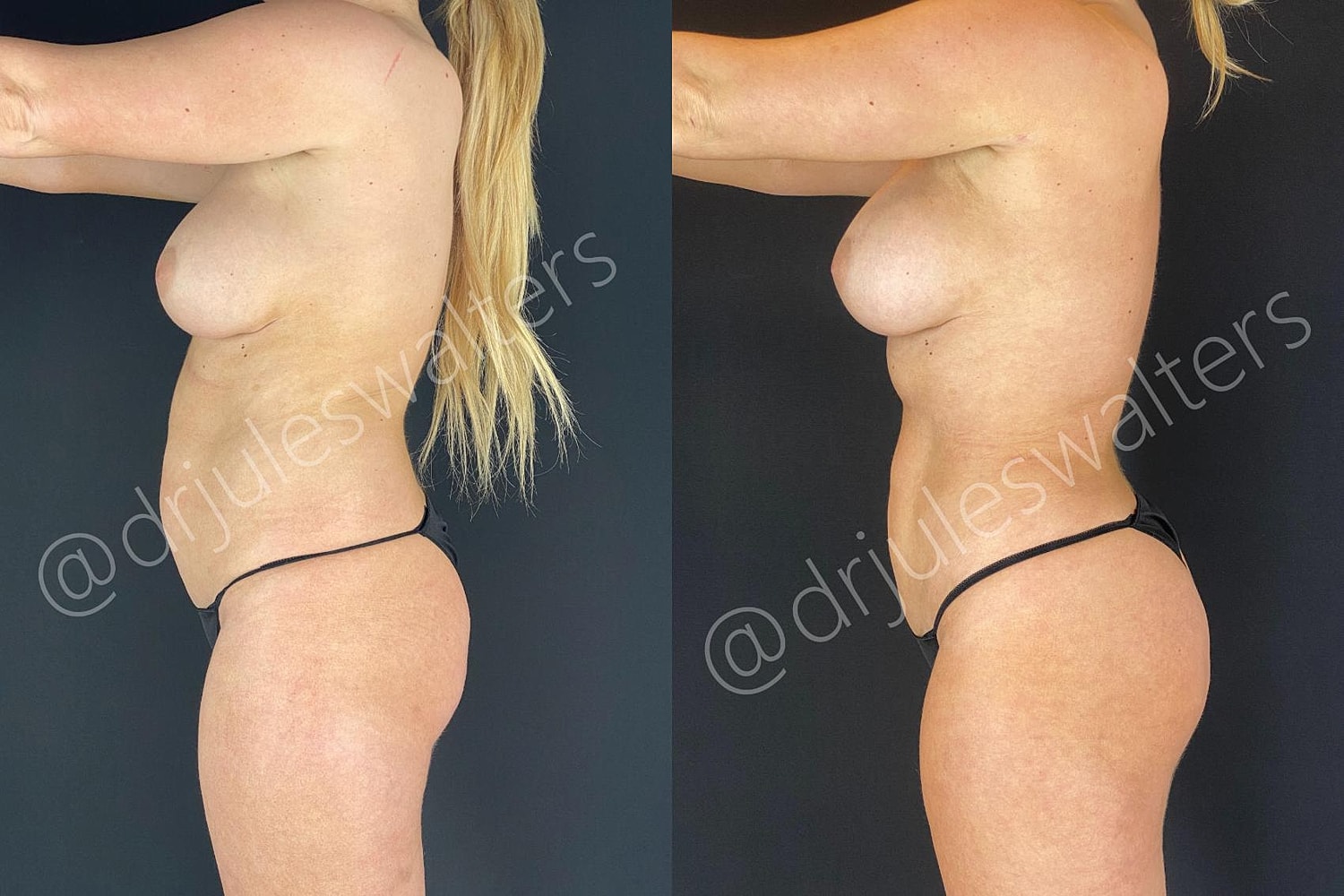 Hidefinition Liposuction Before & After