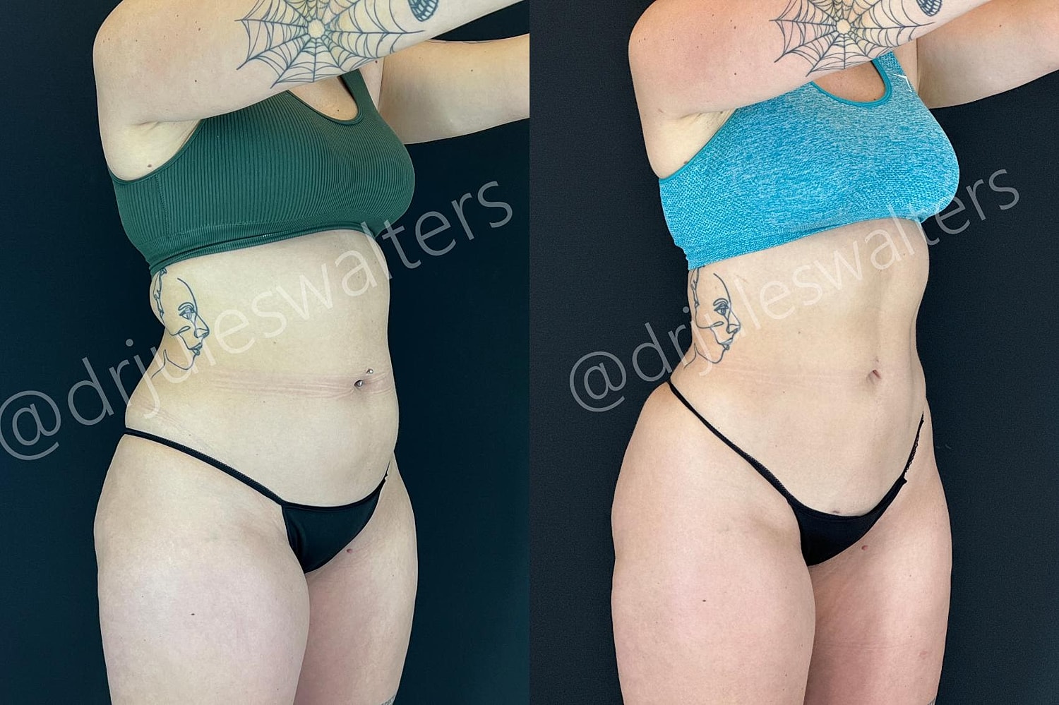 Hidefinition Liposuction Before & After