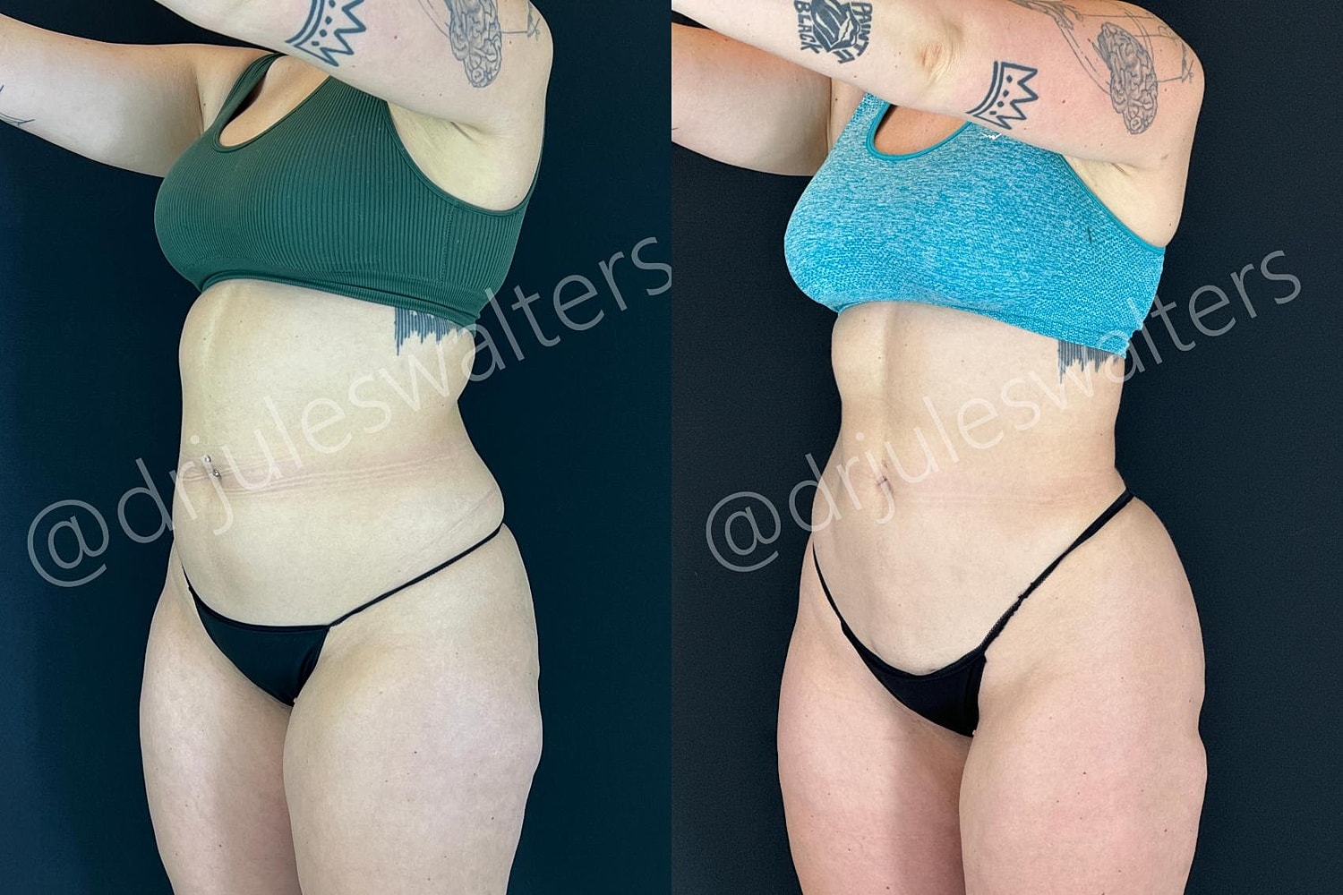 Hidefinition Liposuction Before & After