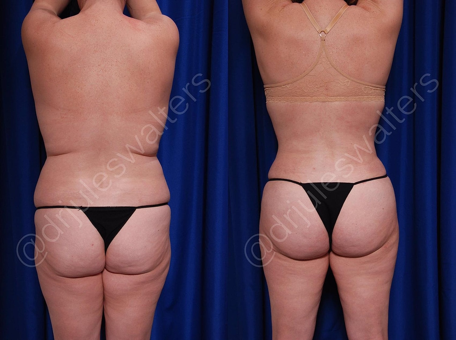 Body Contouring Before & After