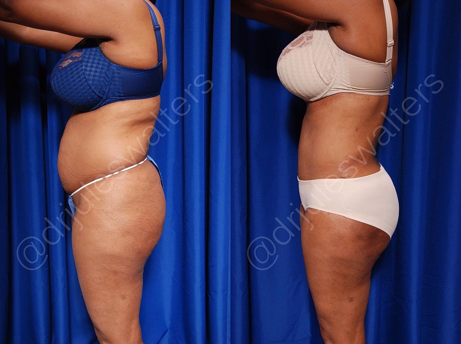 Body Contouring Before & After