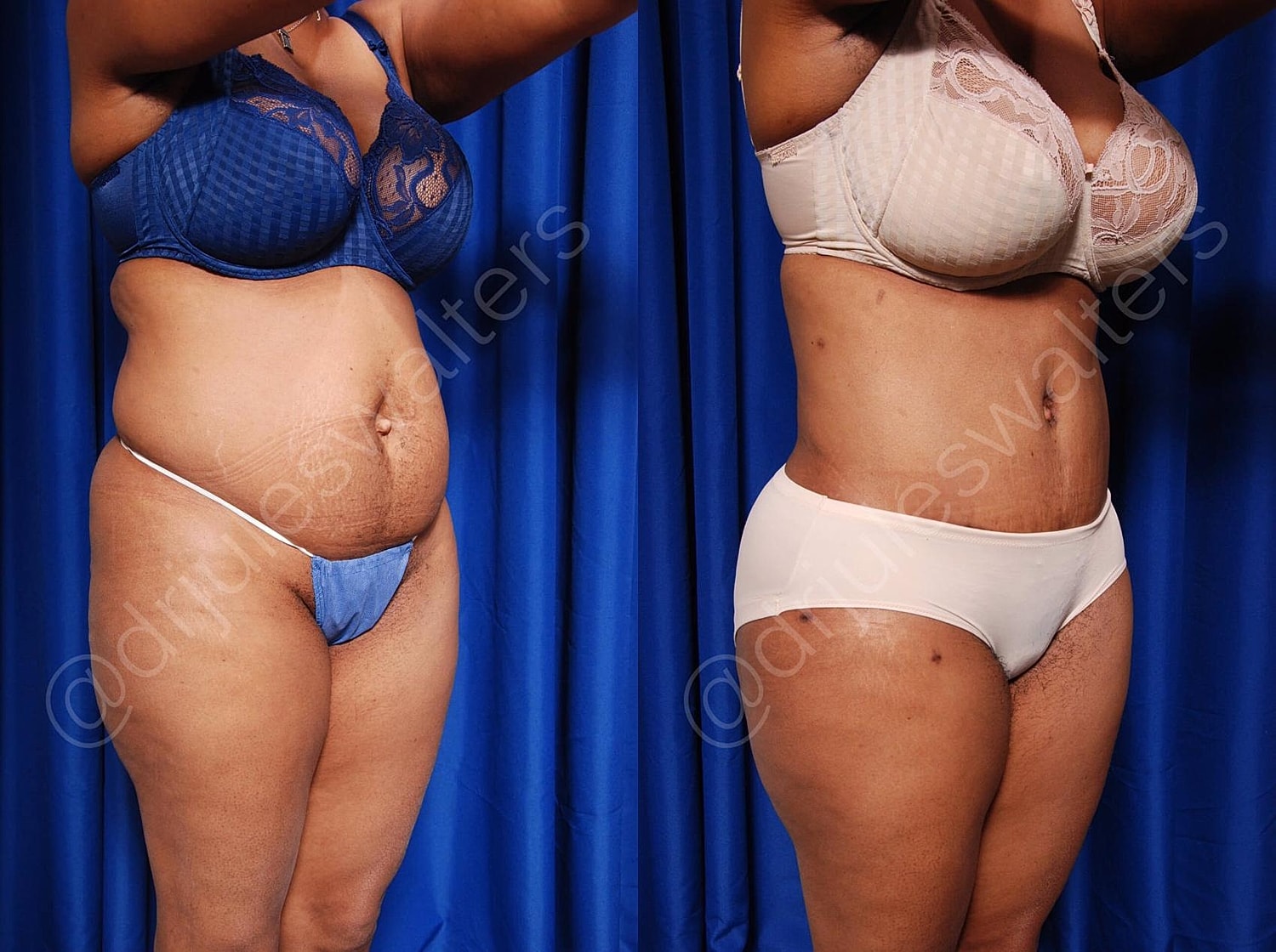Body Contouring Before & After