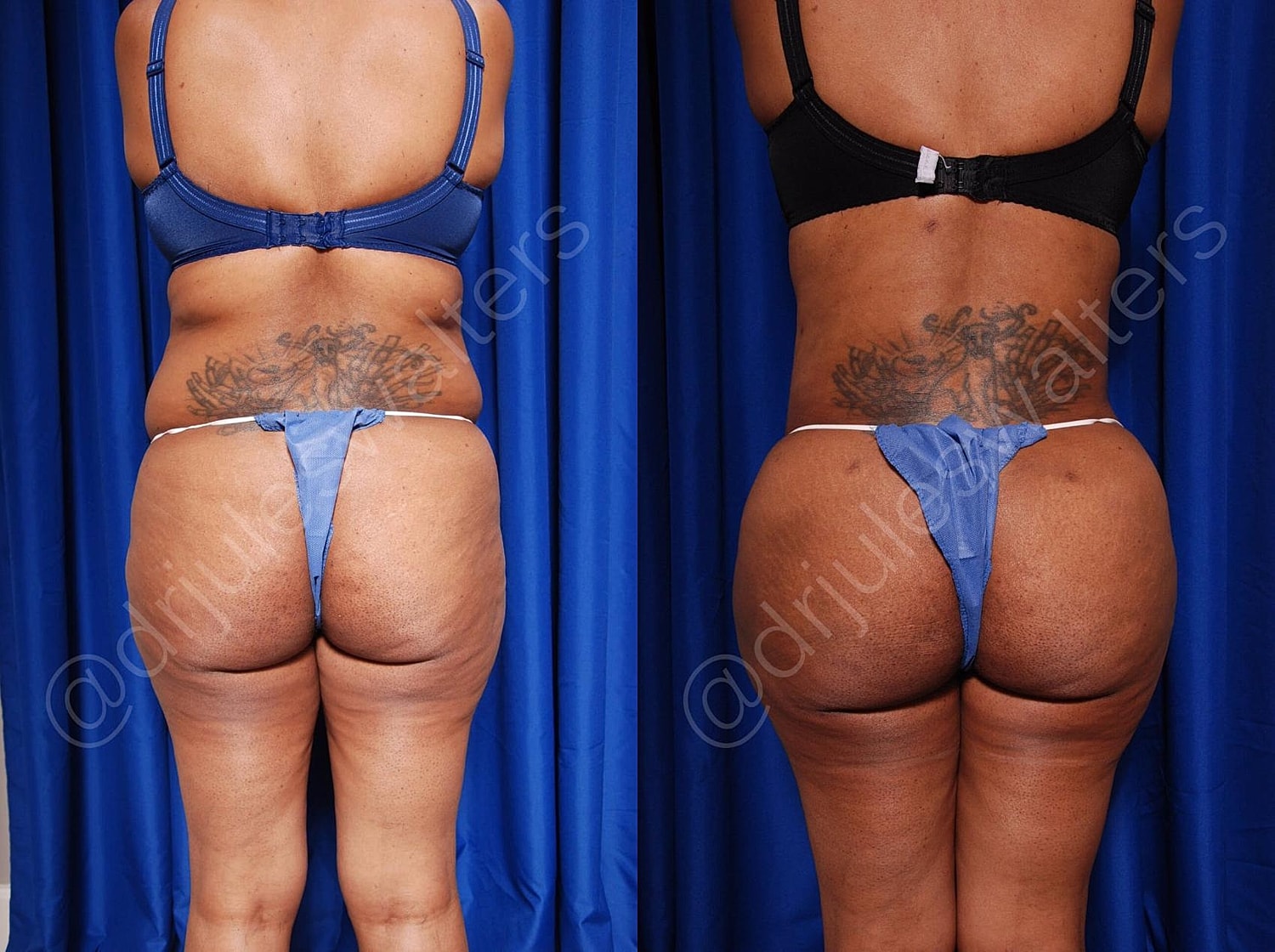 Body Contouring Before & After