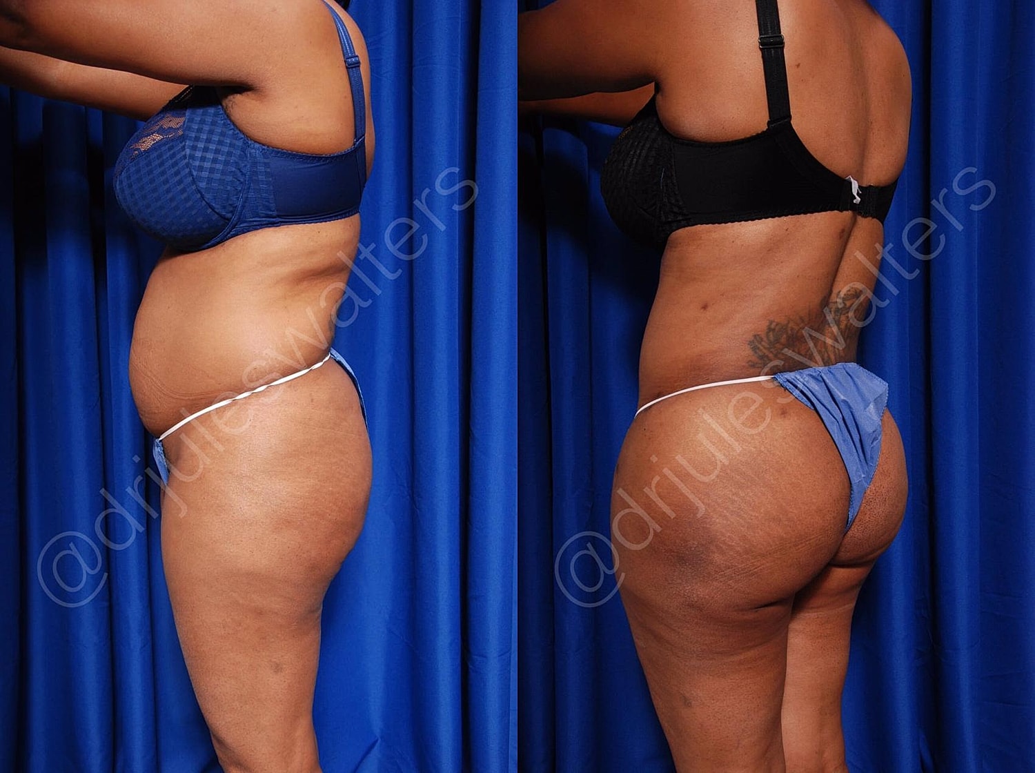 Body Contouring Before & After
