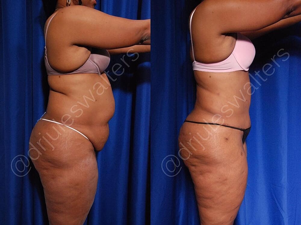 Body Contouring Before & After