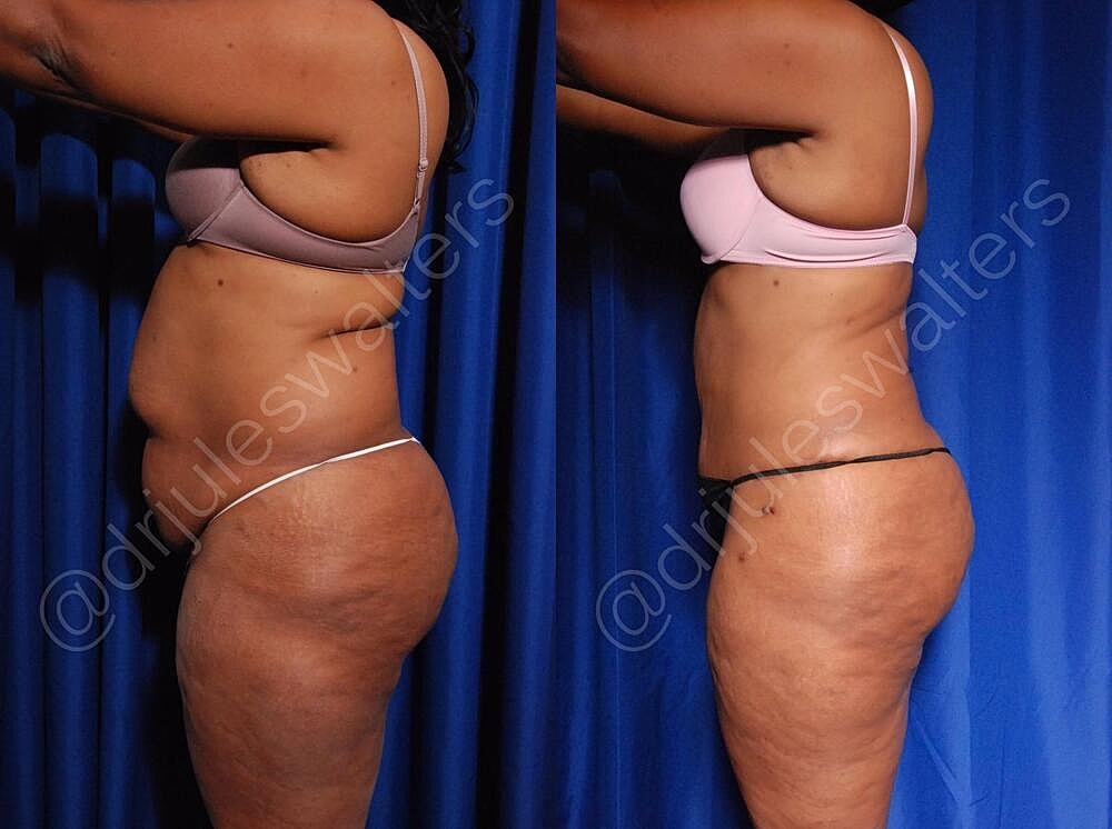 Body Contouring Before & After