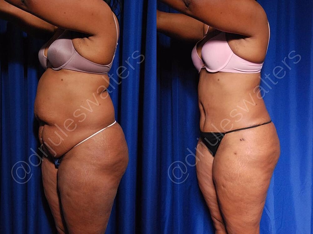 Body Contouring Before & After