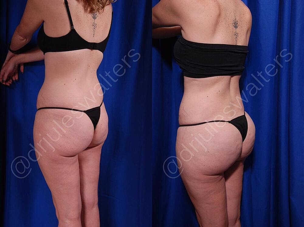 Body Contouring Before & After