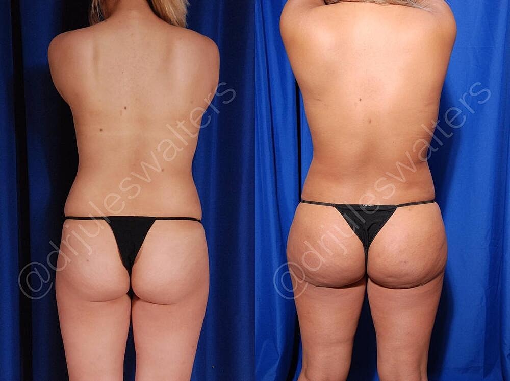Body Contouring Before & After