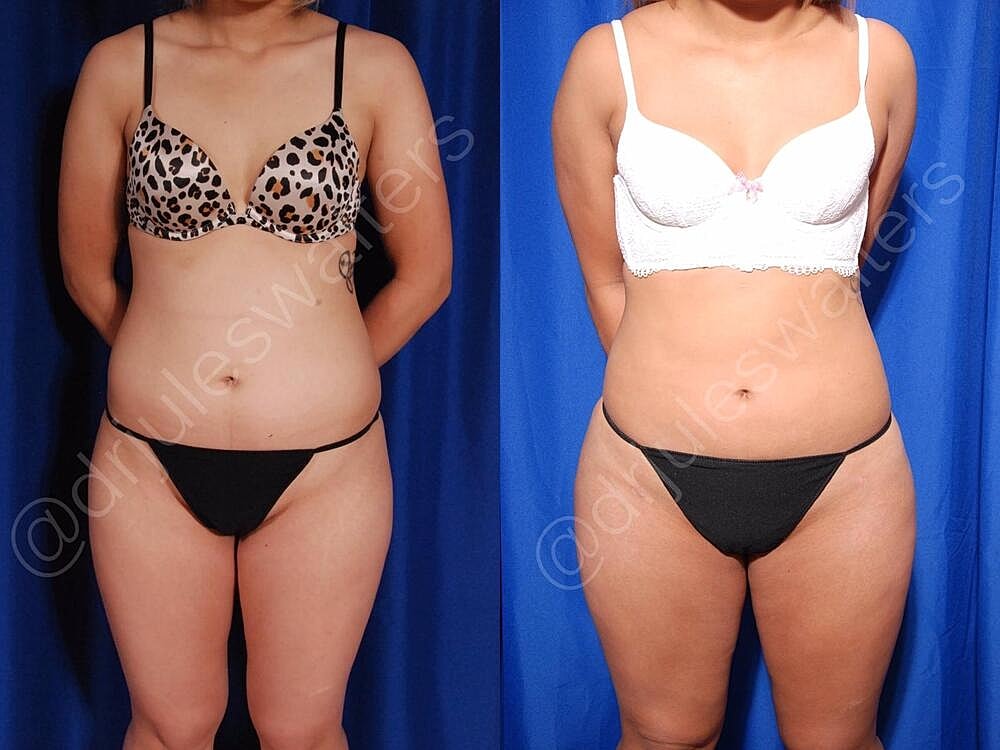 Body Contouring Before & After