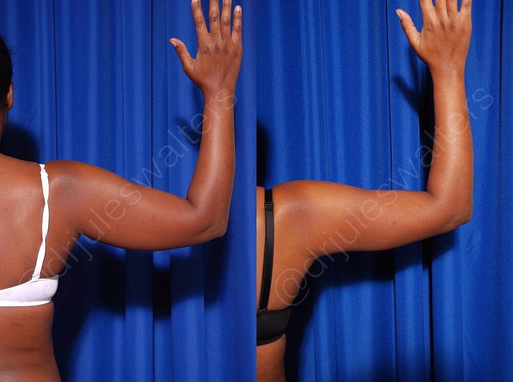 Body Contouring Before & After