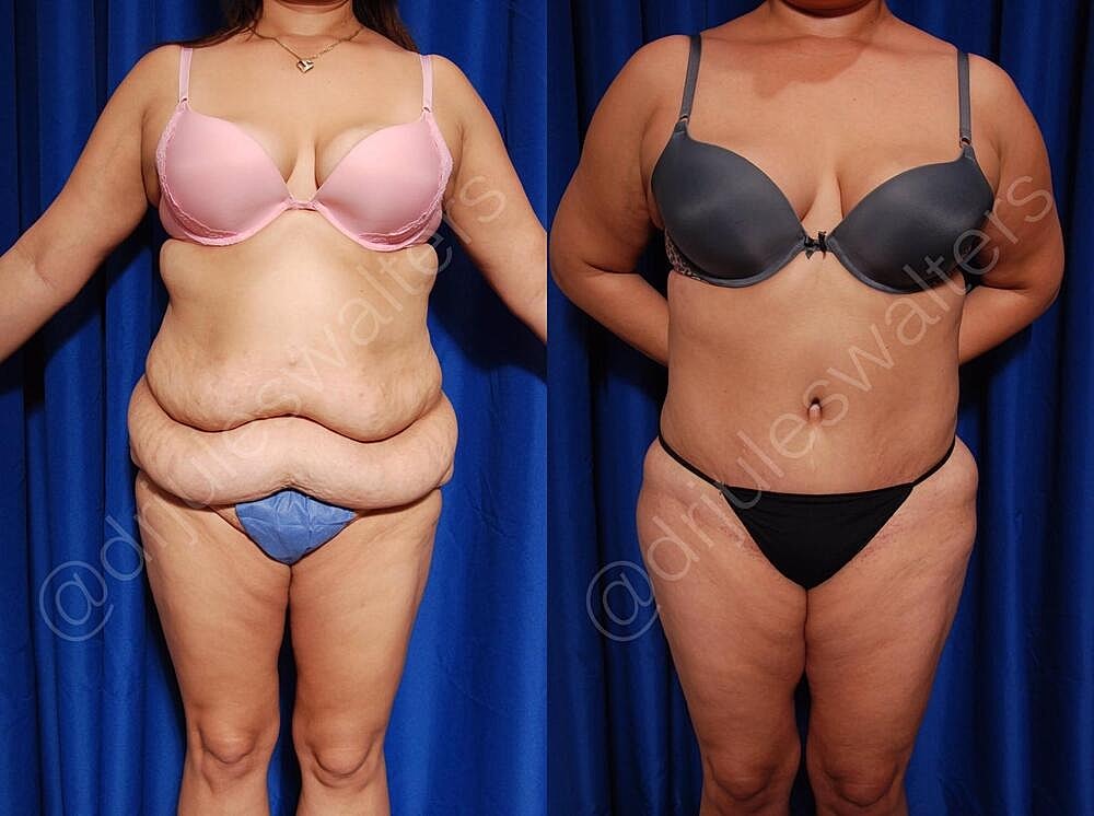 Body Contouring Before & After