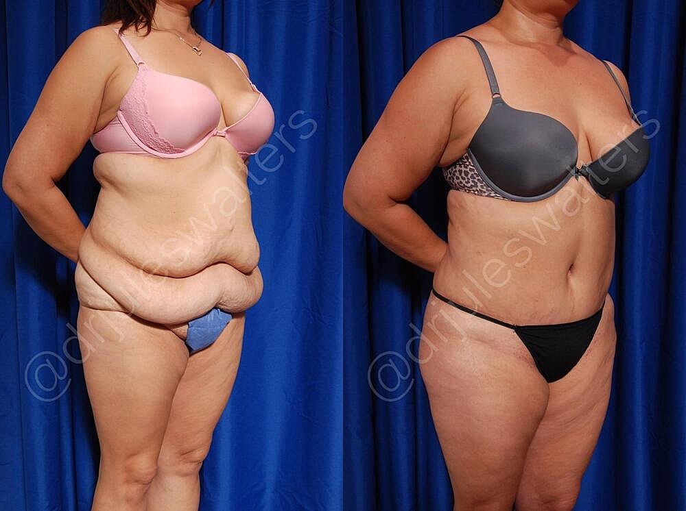 Body Contouring Before & After