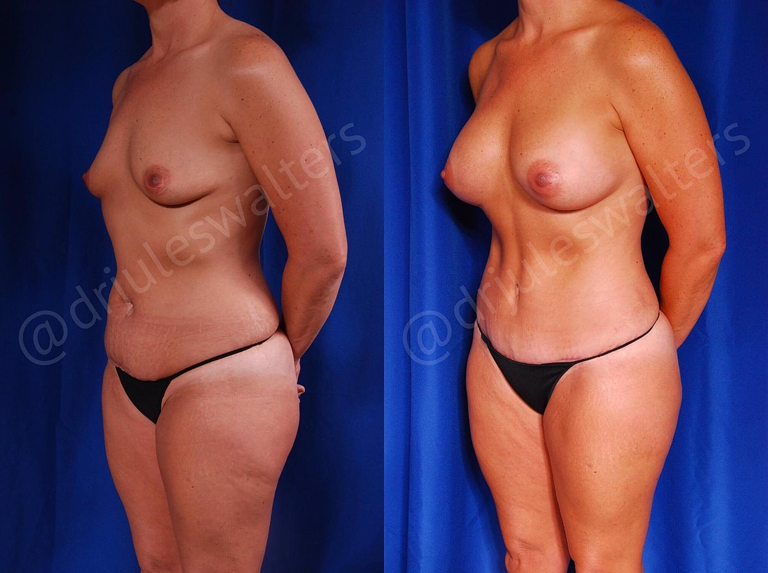 Mommy Makeover Before & After