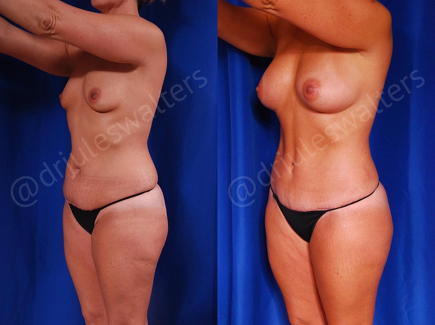 Mommy Makeover Before & After