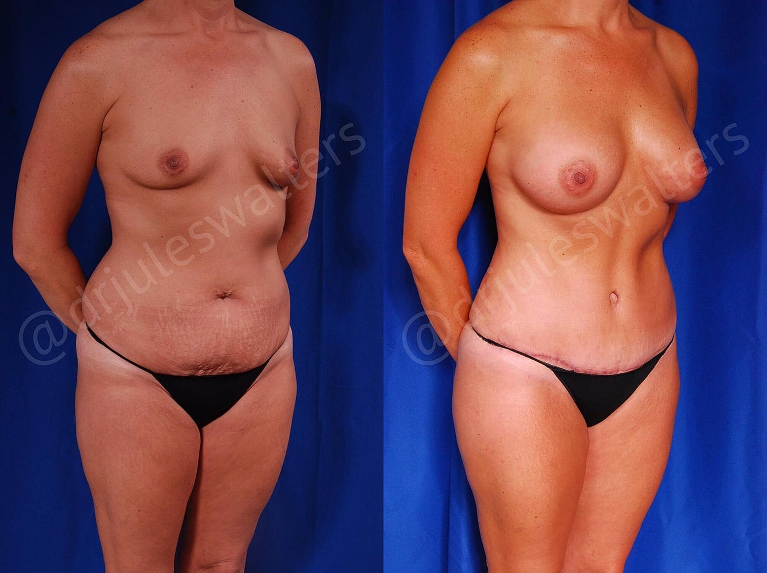 Mommy Makeover Before & After