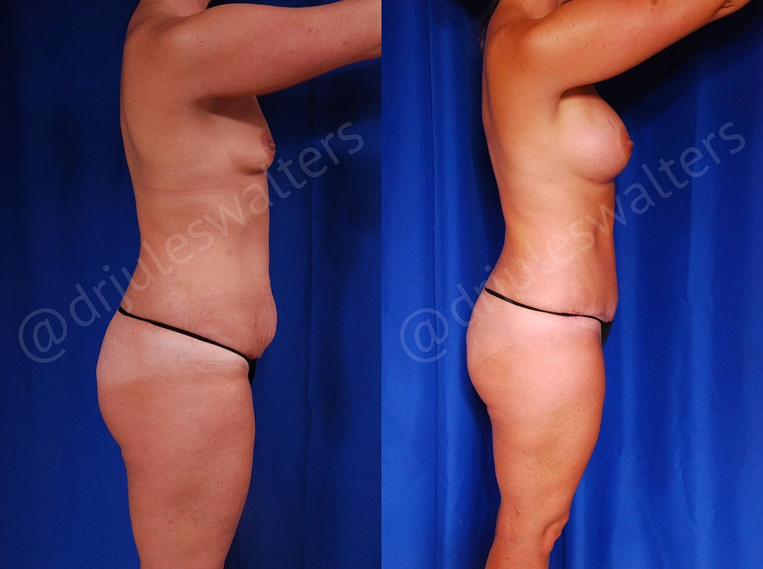 Mommy Makeover Before & After