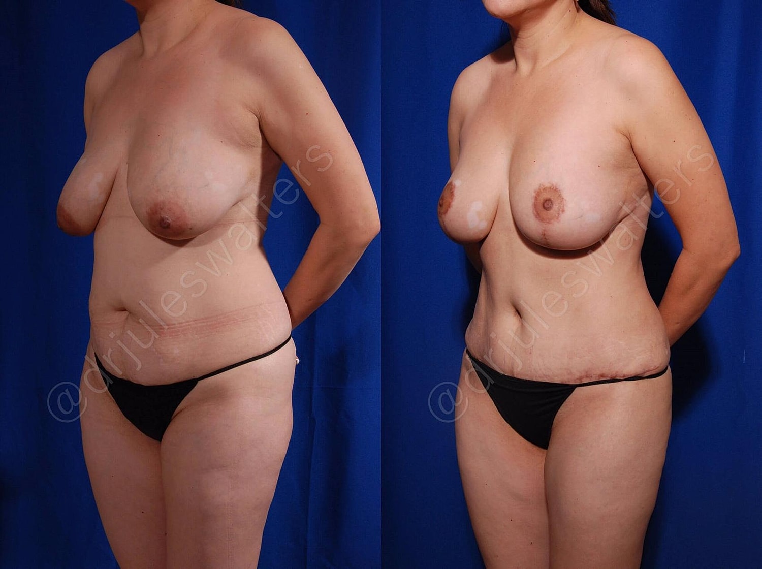 Mommy Makeover Before & After