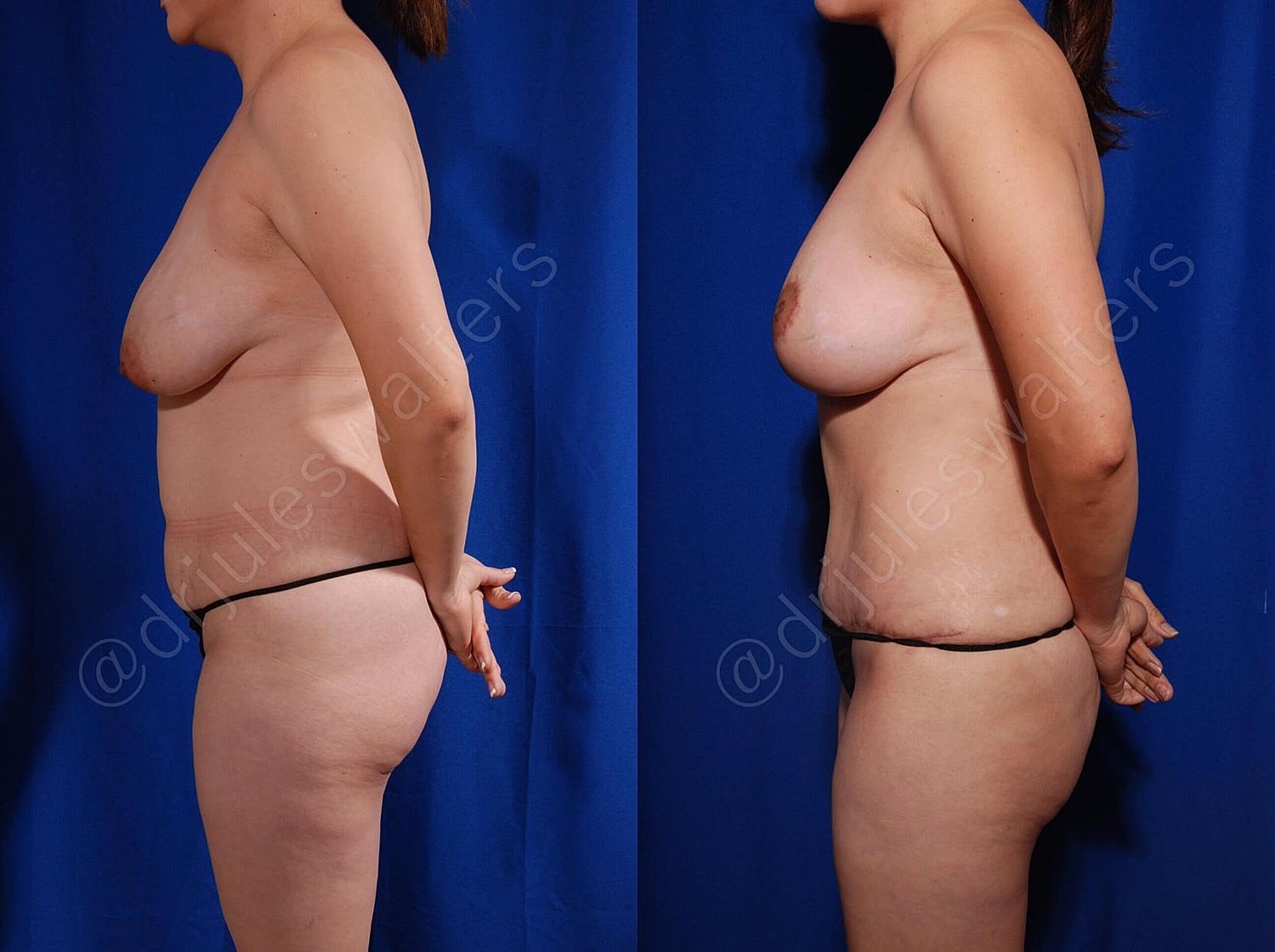 Mommy Makeover Before & After