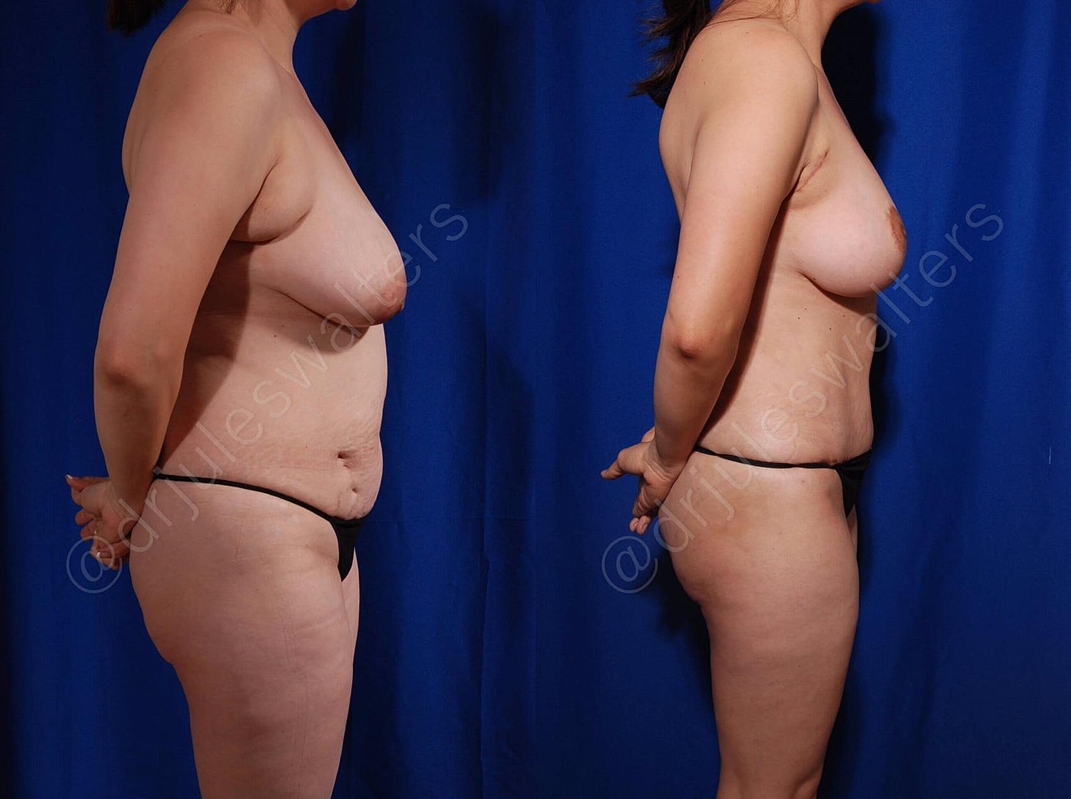 Mommy Makeover Before & After