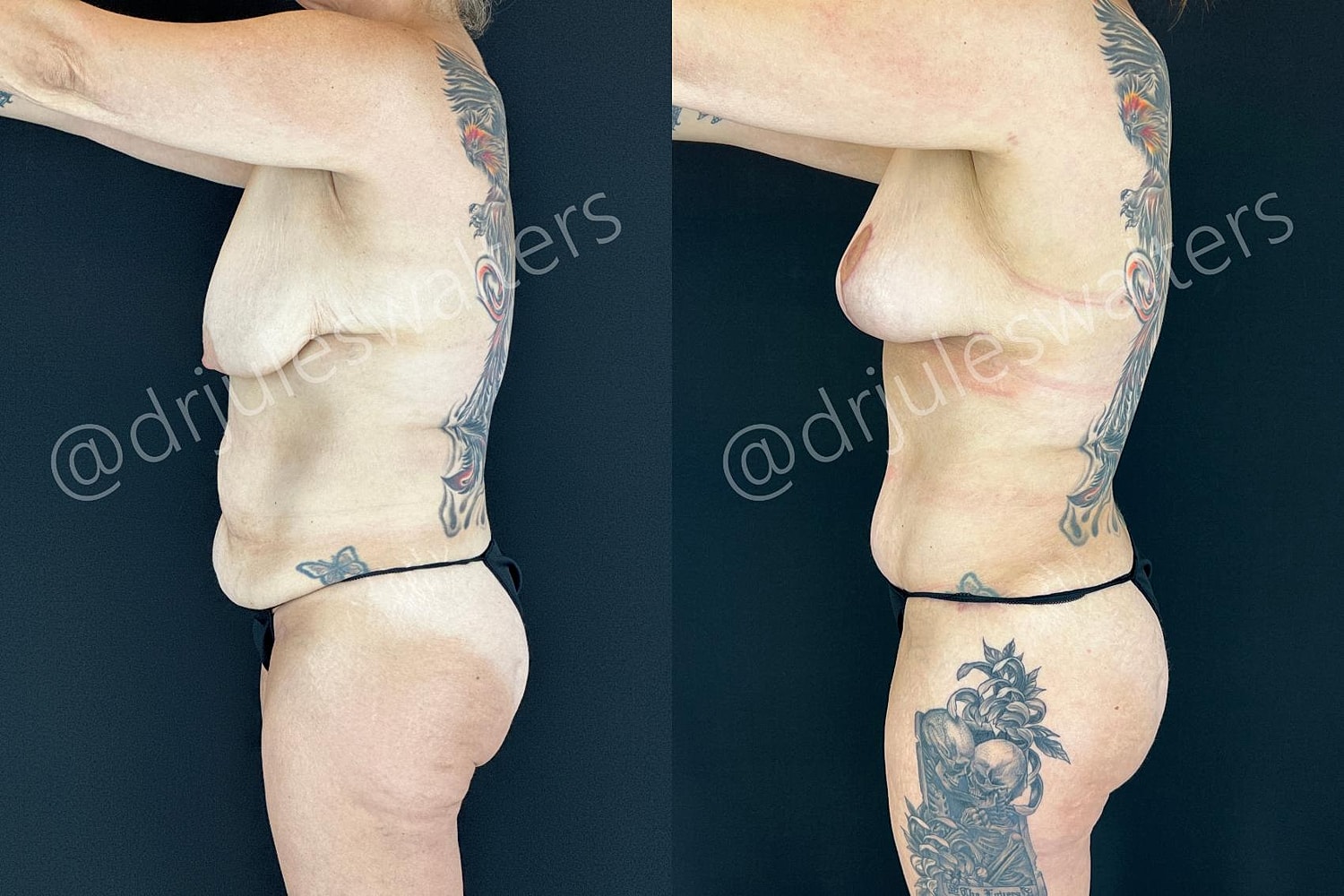 Mommy Makeover Before & After