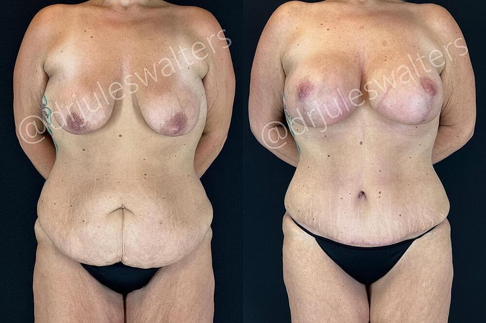 Mommy Makeover Before & After