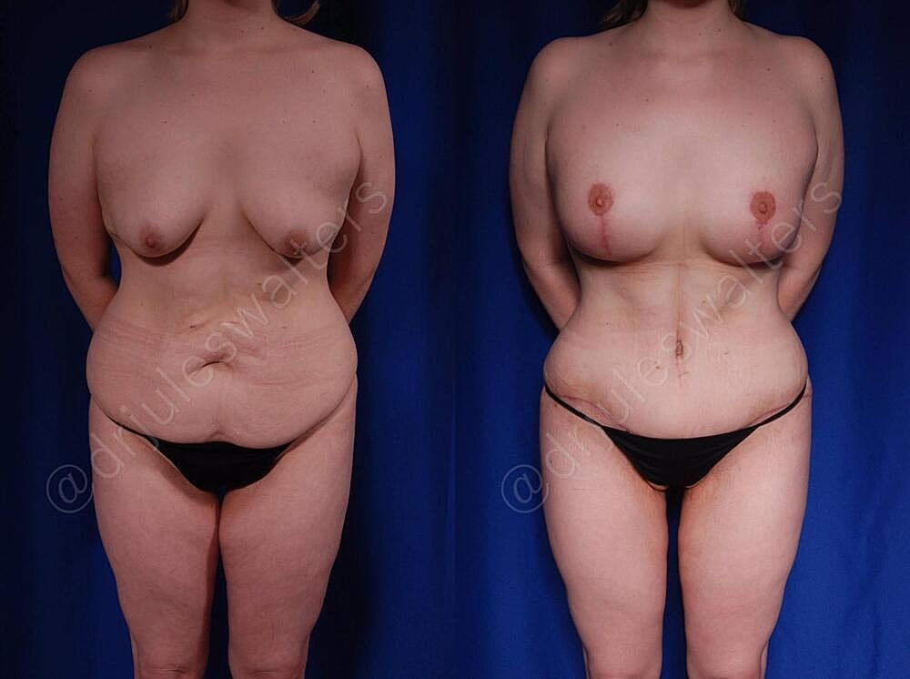 Mommy Makeover Before & After