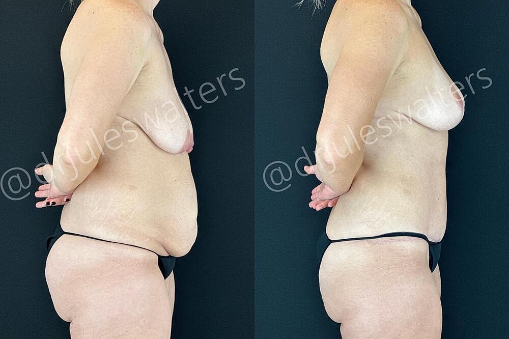 Mommy Makeover Before & After