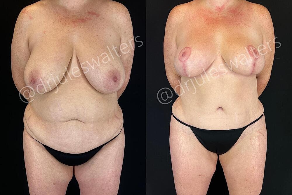 Mommy Makeover Before & After