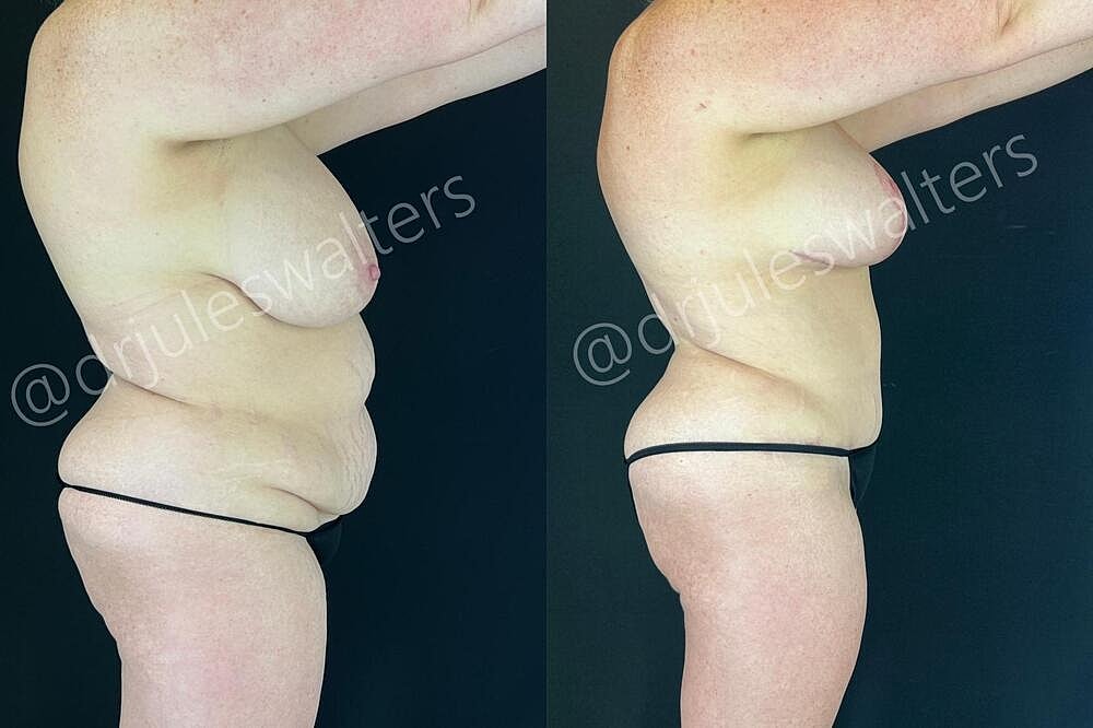 Mommy Makeover Before & After