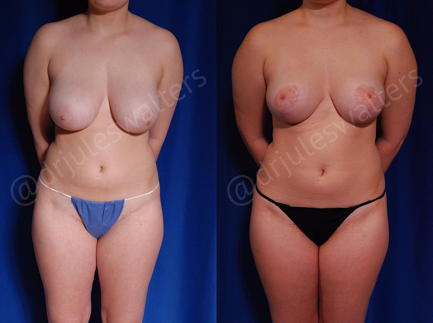 Breast Reduction Before & After