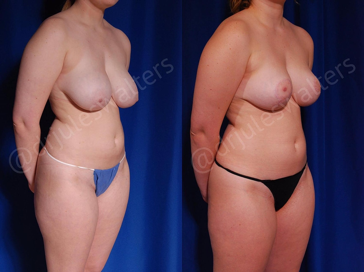 Breast Reduction Before & After
