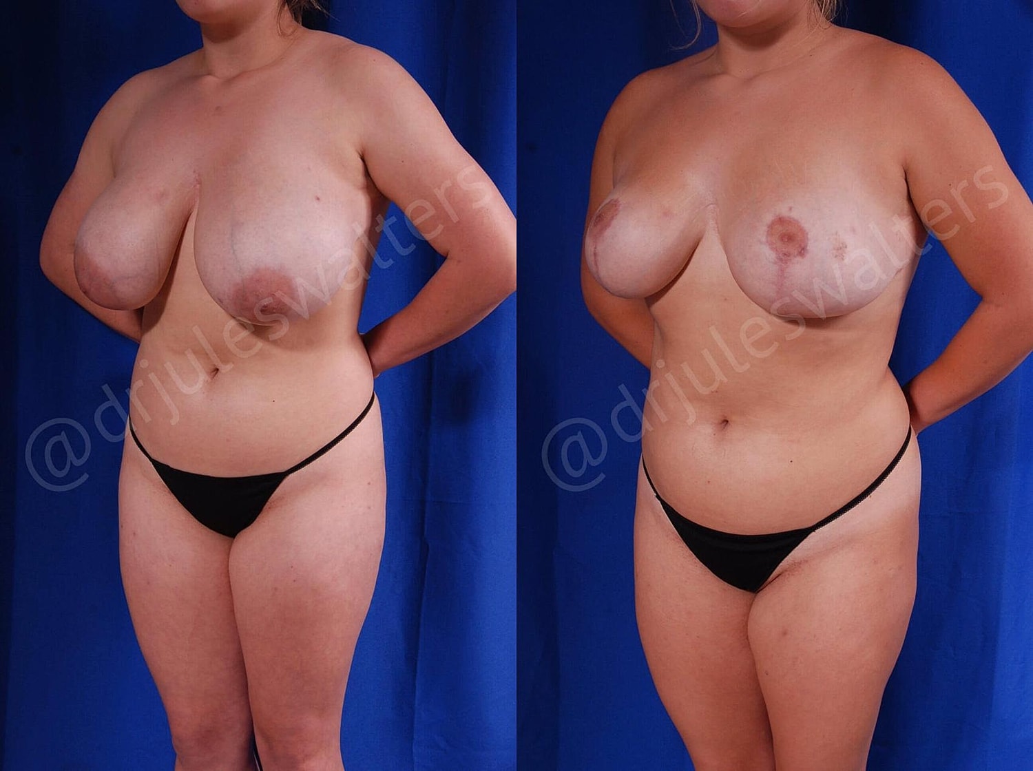 Breast Reduction Before & After
