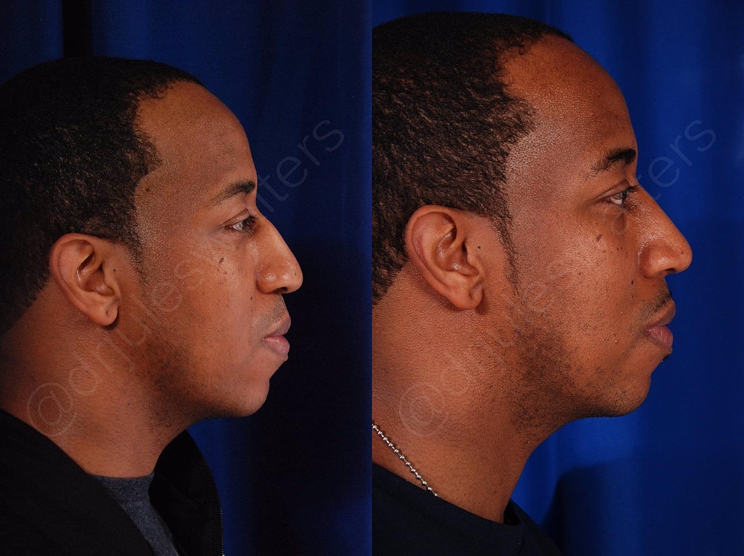 Rhinoplasty Before & After