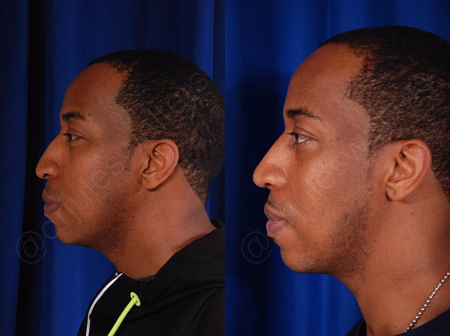 Rhinoplasty Before & After