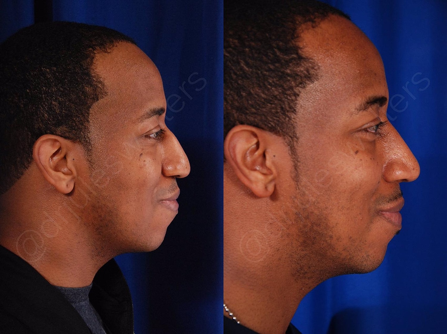 Rhinoplasty Before & After
