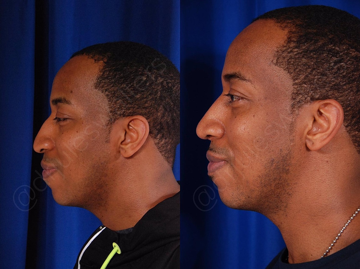 Rhinoplasty Before & After