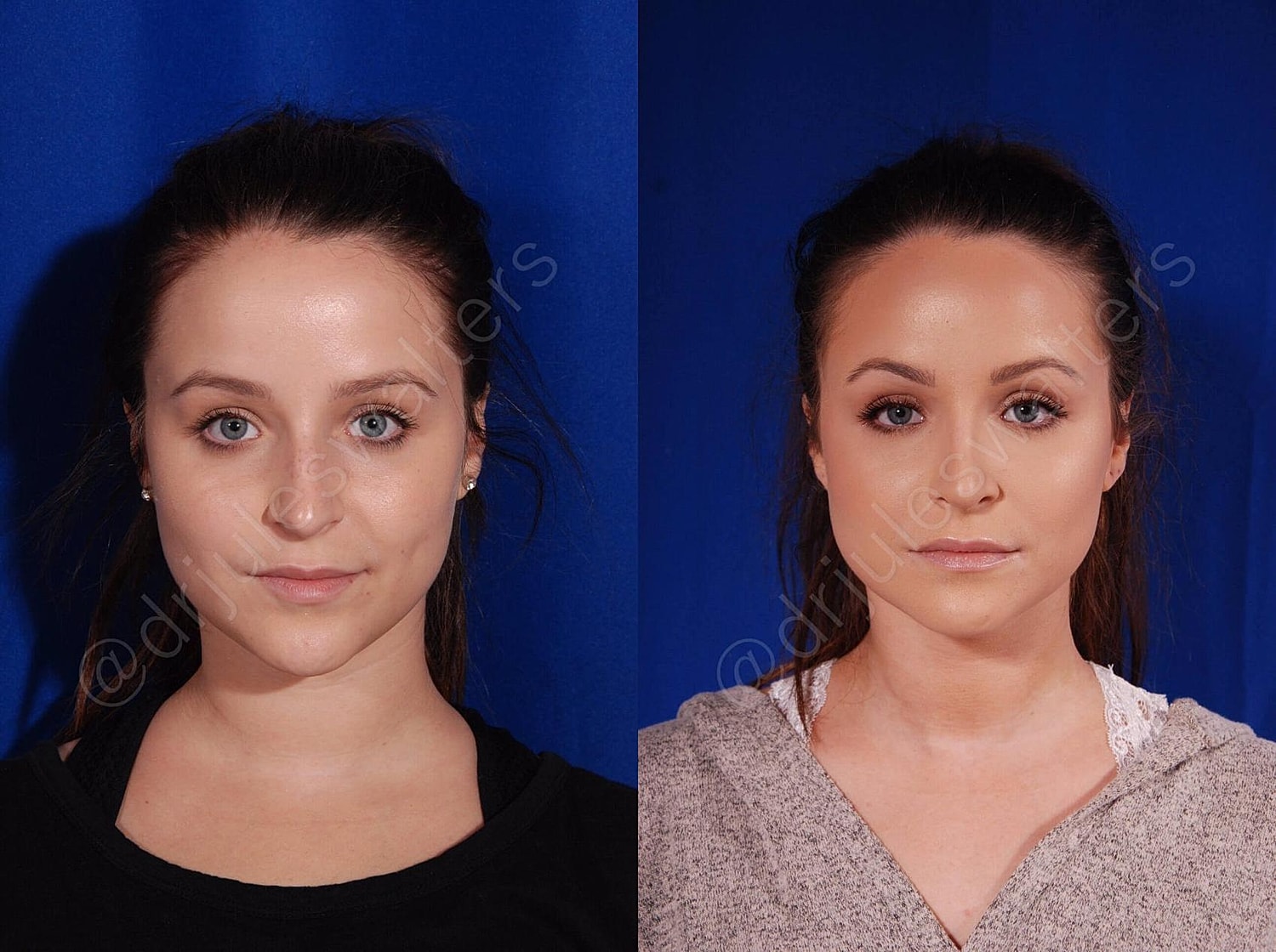 Rhinoplasty Before & After