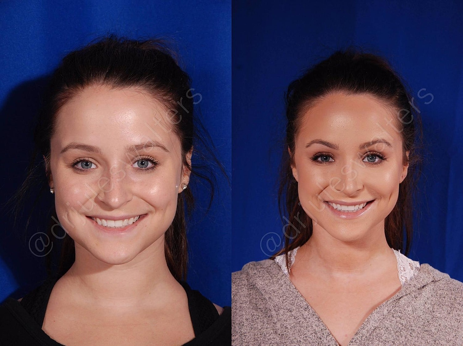 Rhinoplasty Before & After