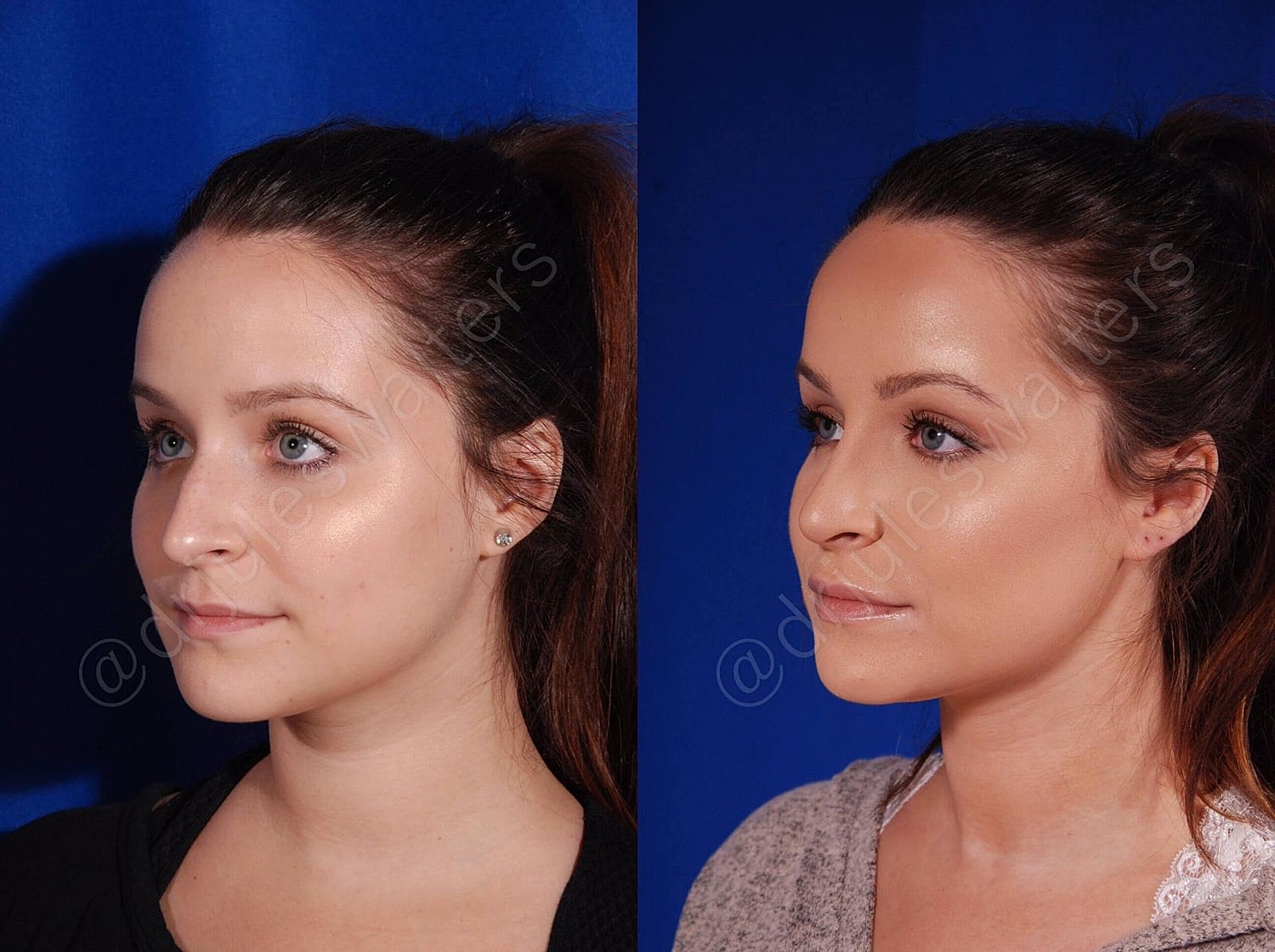 Rhinoplasty Before & After