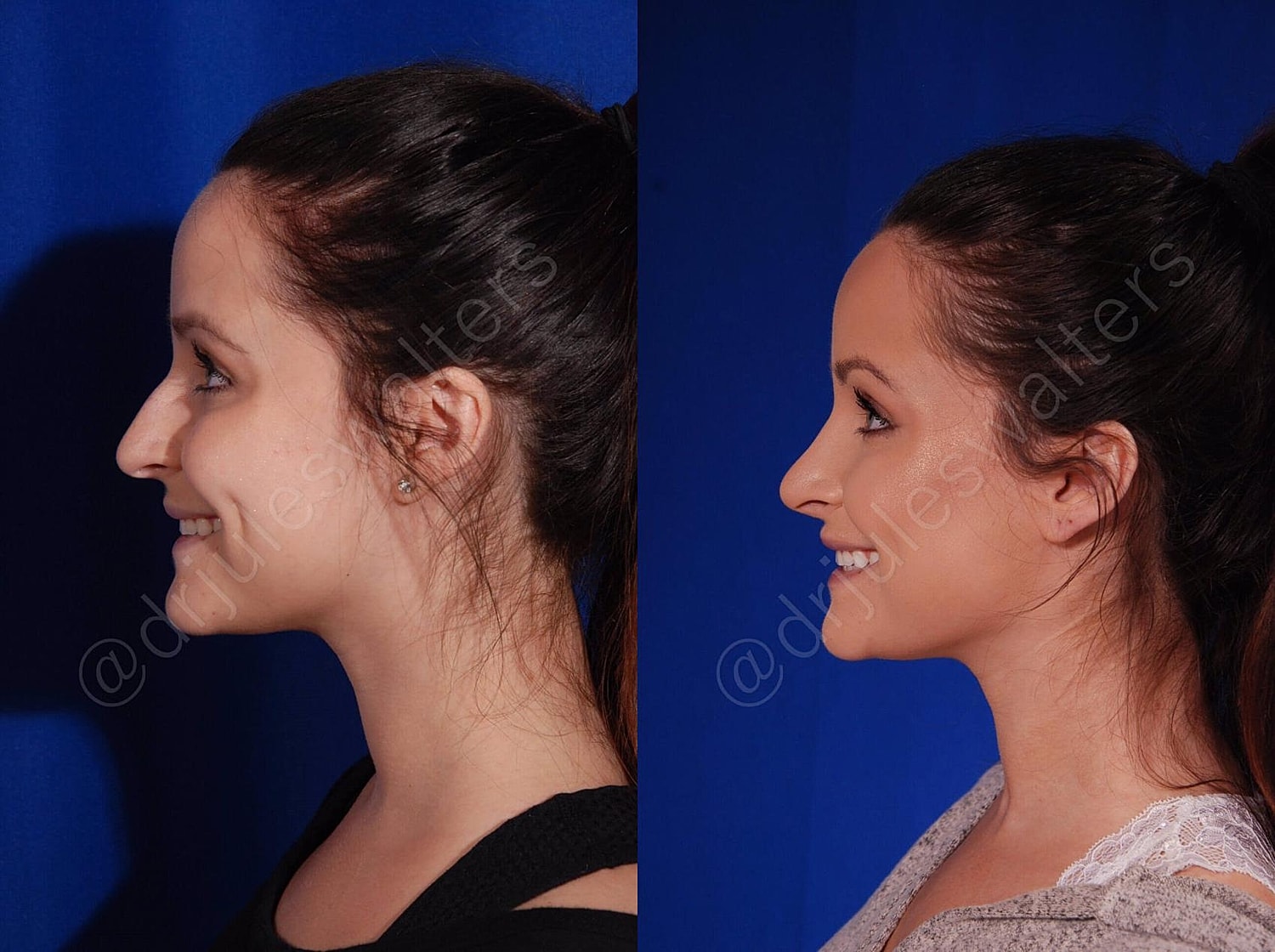 Rhinoplasty Before & After