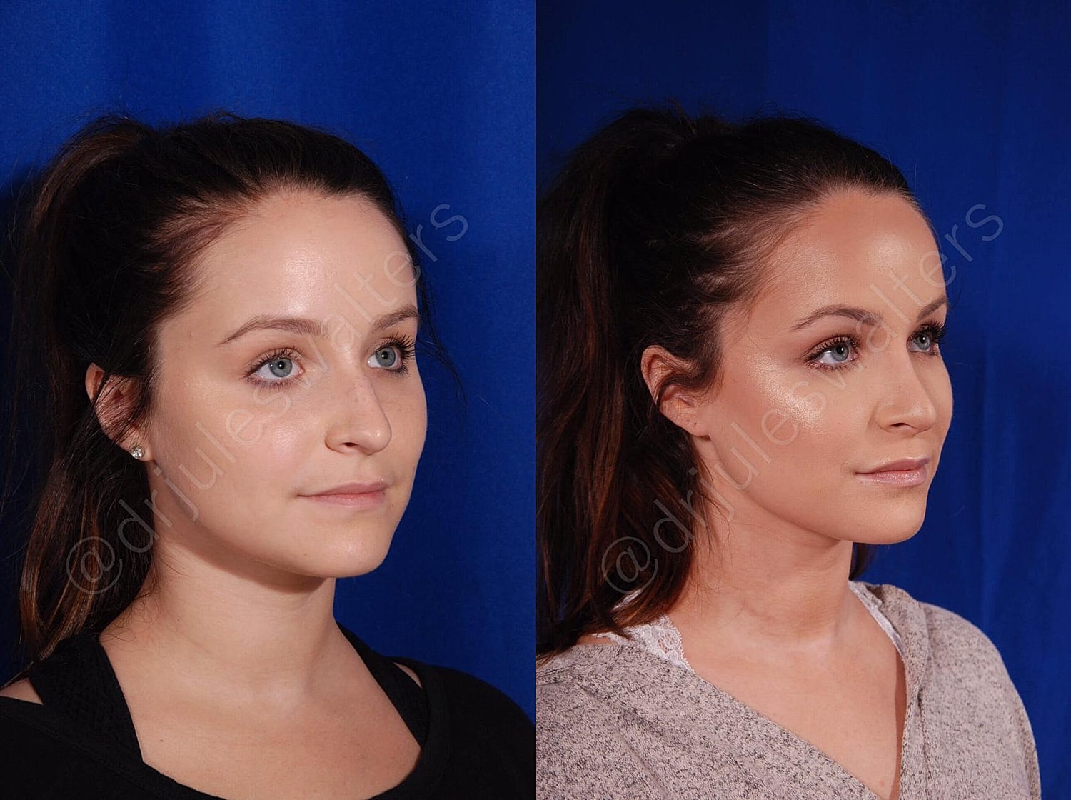 Rhinoplasty Before & After