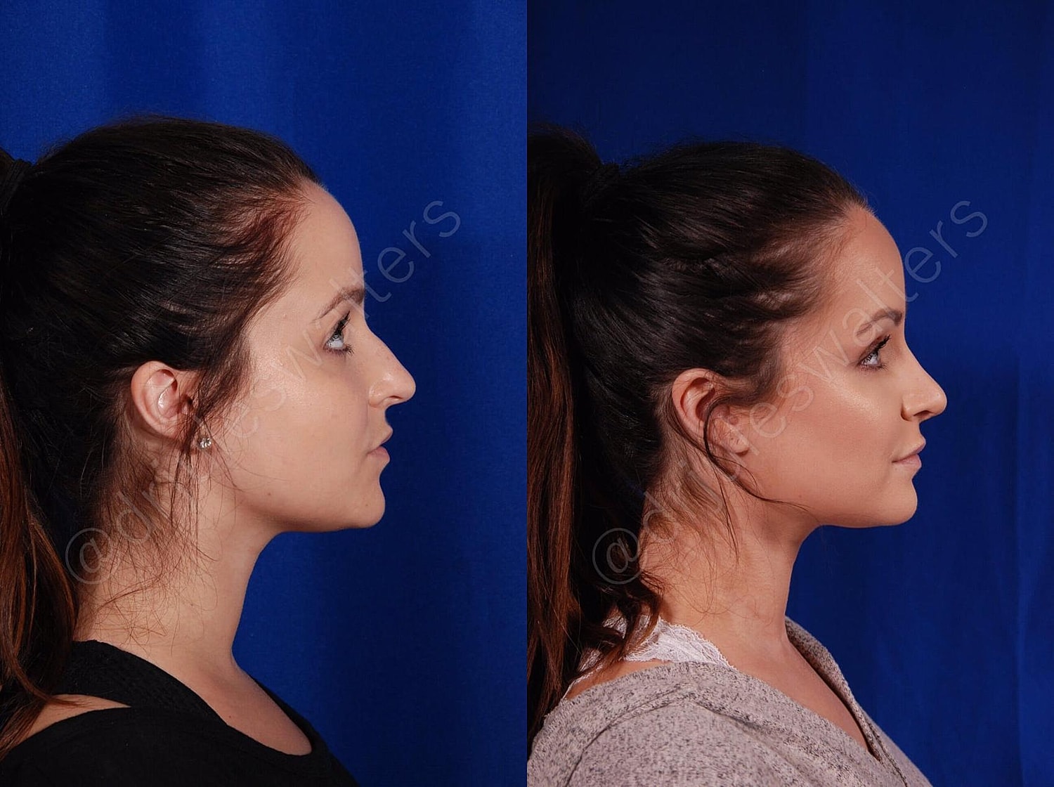 Rhinoplasty Before & After