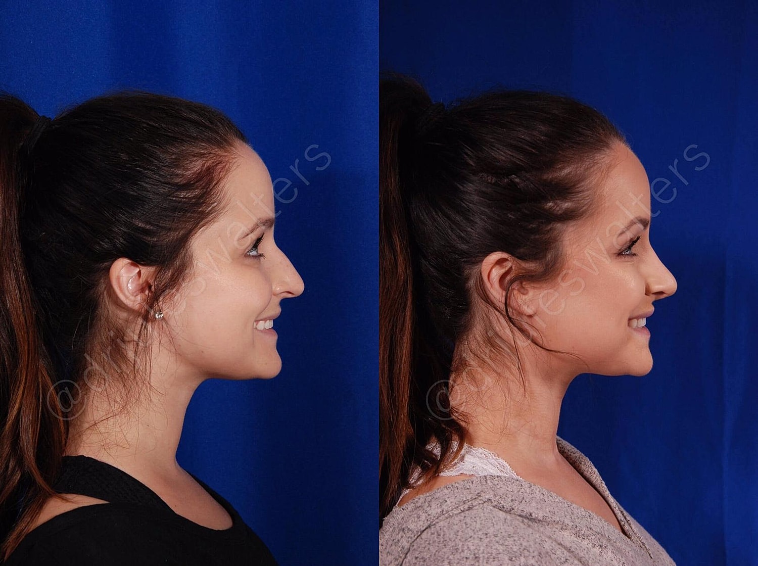 Rhinoplasty Before & After
