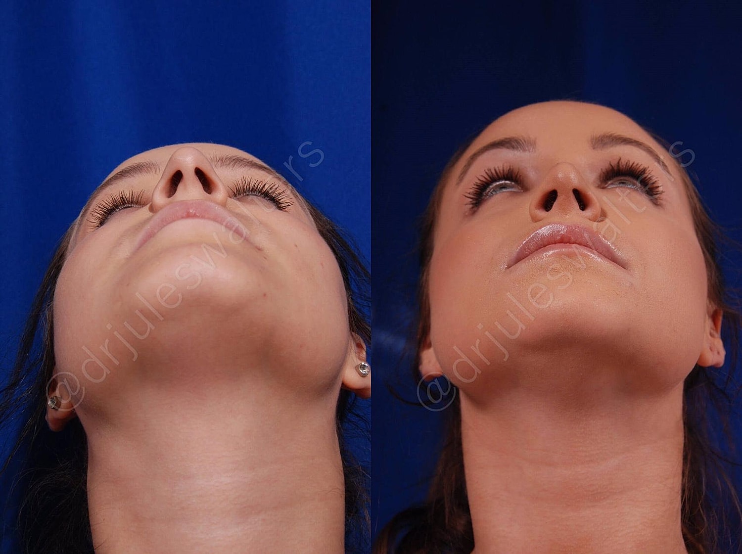 Rhinoplasty Before & After