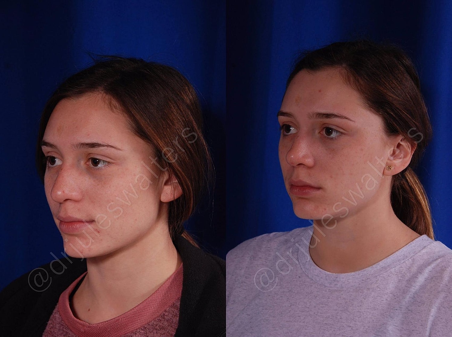 Rhinoplasty Before & After