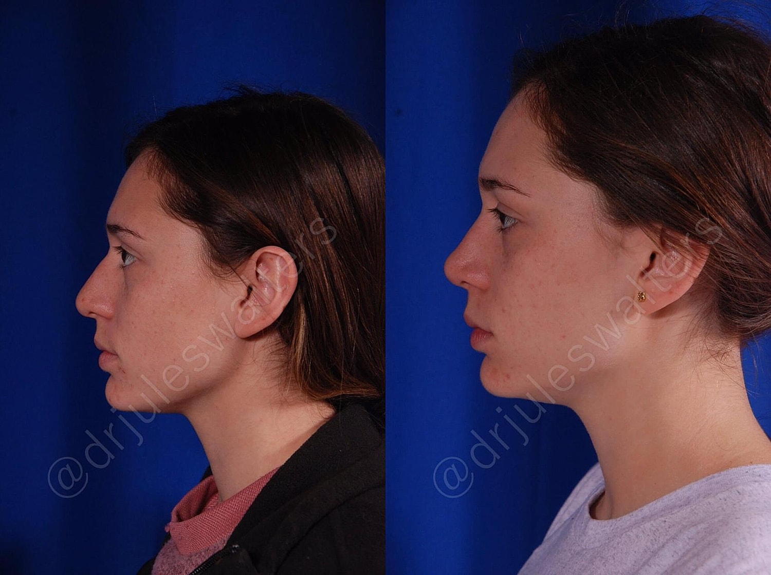 Rhinoplasty Before & After