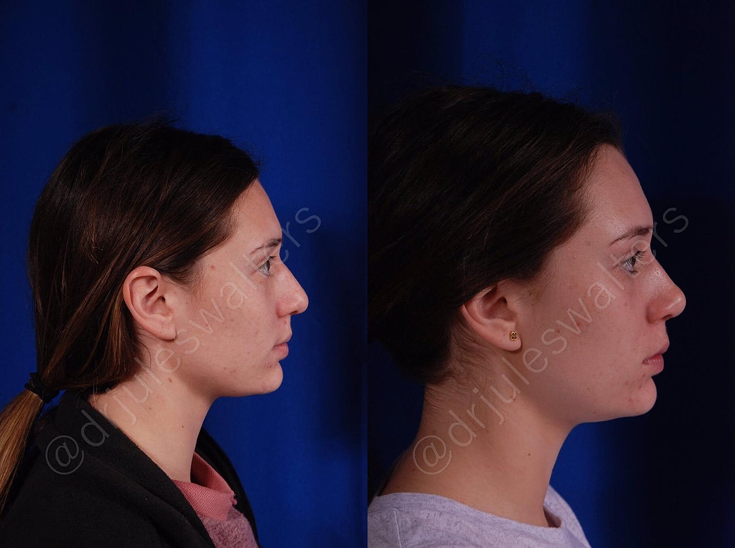 Rhinoplasty Before & After