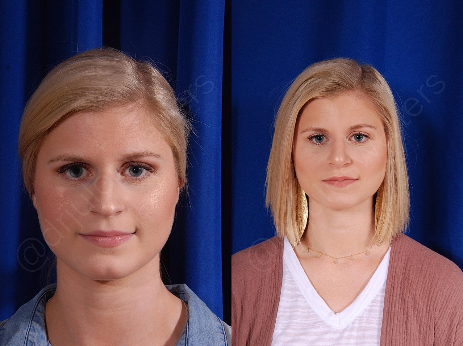Rhinoplasty Before & After