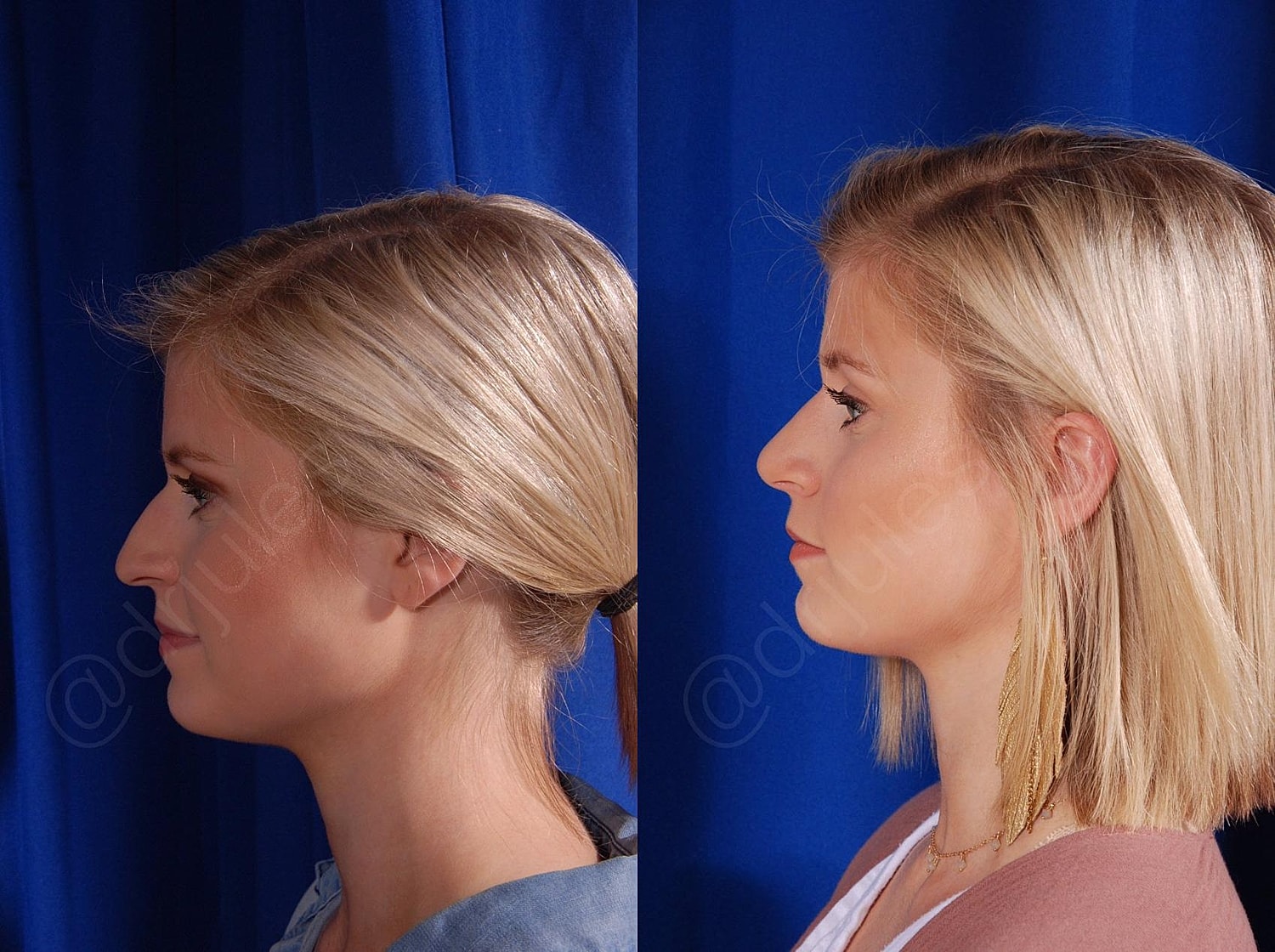 Rhinoplasty Before & After